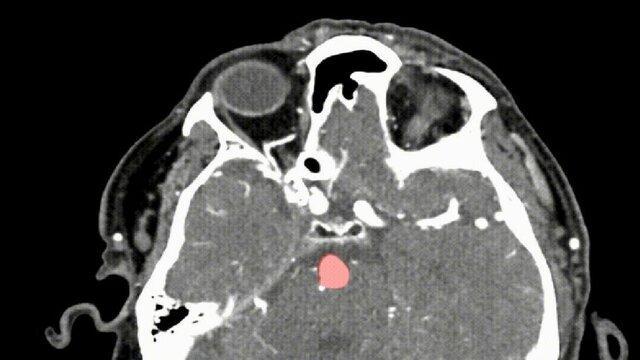 تشخیص آنوریسم مغزی با یاری هوش مصنوعی